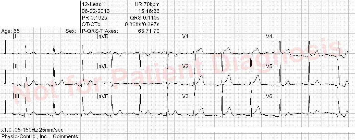 ekg practice exam with answers