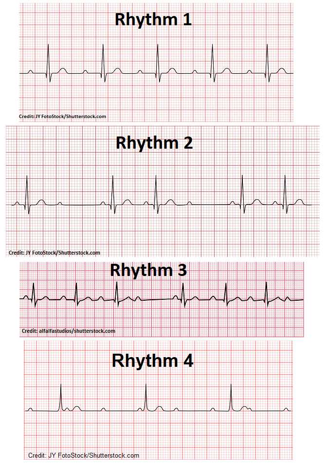 ekg practice exam with answers