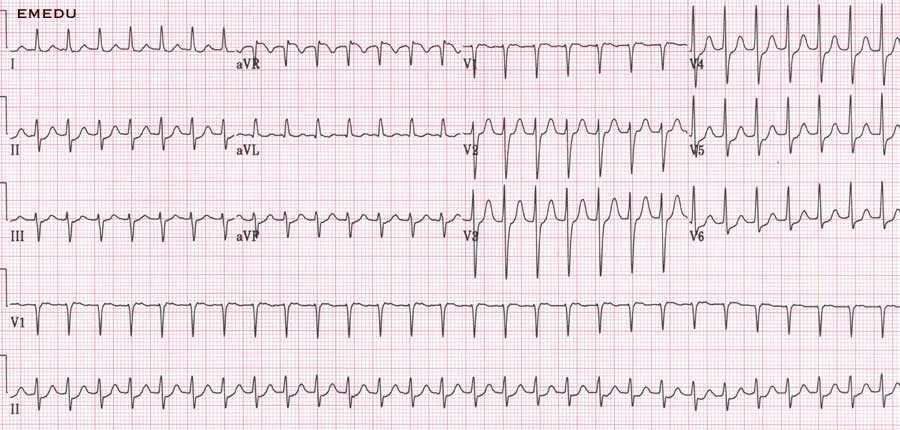 ekg practice exam with answers