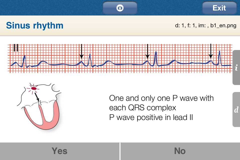 upstate medical university ekg rhythm interpretation exam answers