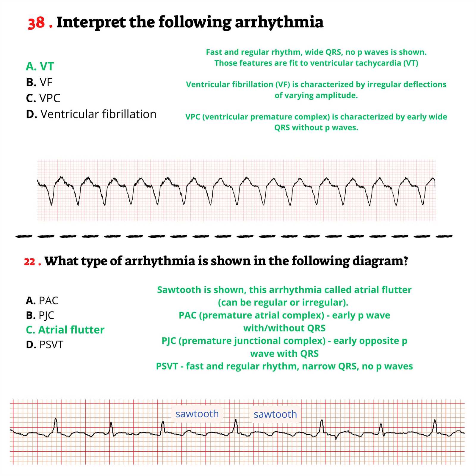 upstate medical university ekg rhythm interpretation exam answers