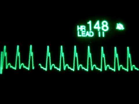 upstate medical university ekg rhythm interpretation exam answers