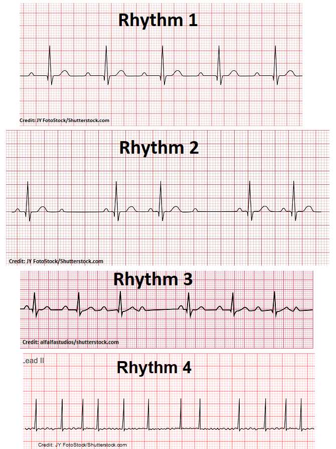 rn.com dysrhythmia exam answers