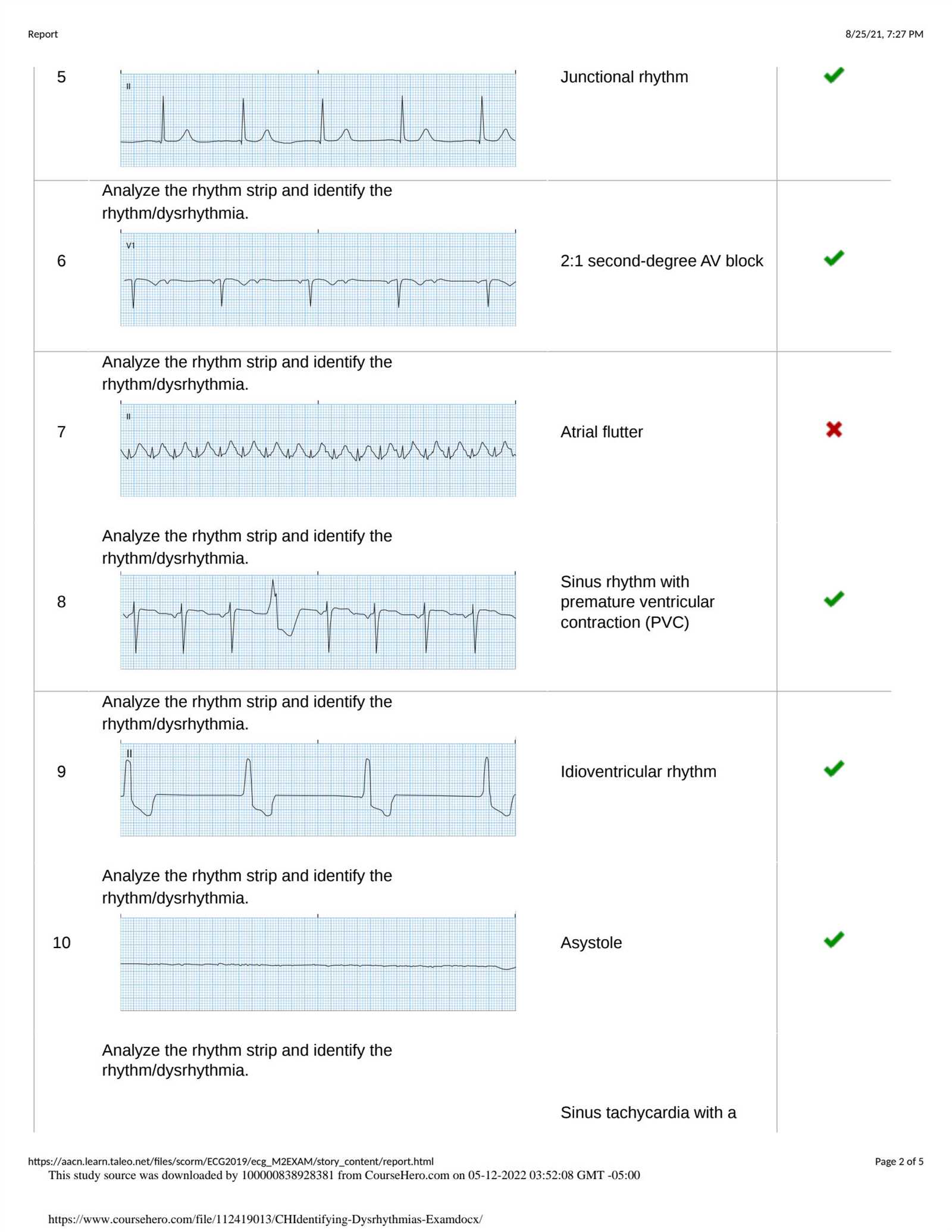 upstate medical university ekg rhythm interpretation exam answers