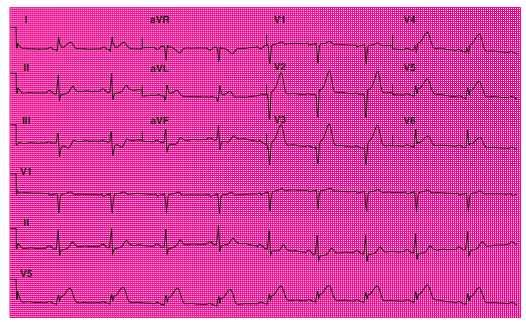 acls post test answer key 2025